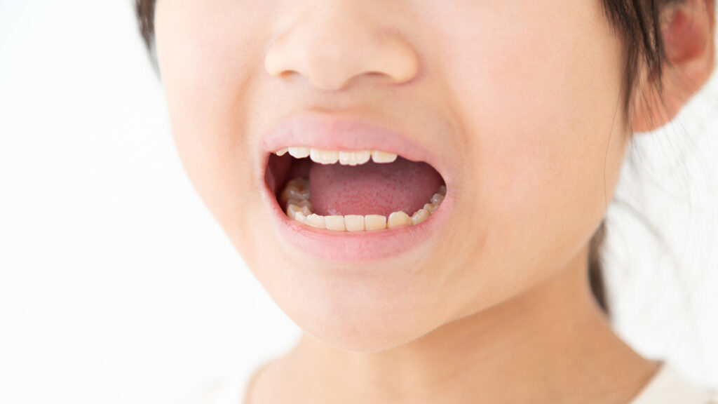 インビザライン・ファーストとは？のイメージ